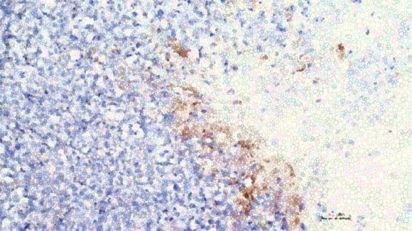 Featured image for “ChristianaCare Researchers Report CRISPR Breakthrough to Re-Sensitize Lung Cancer to Chemotherapy”